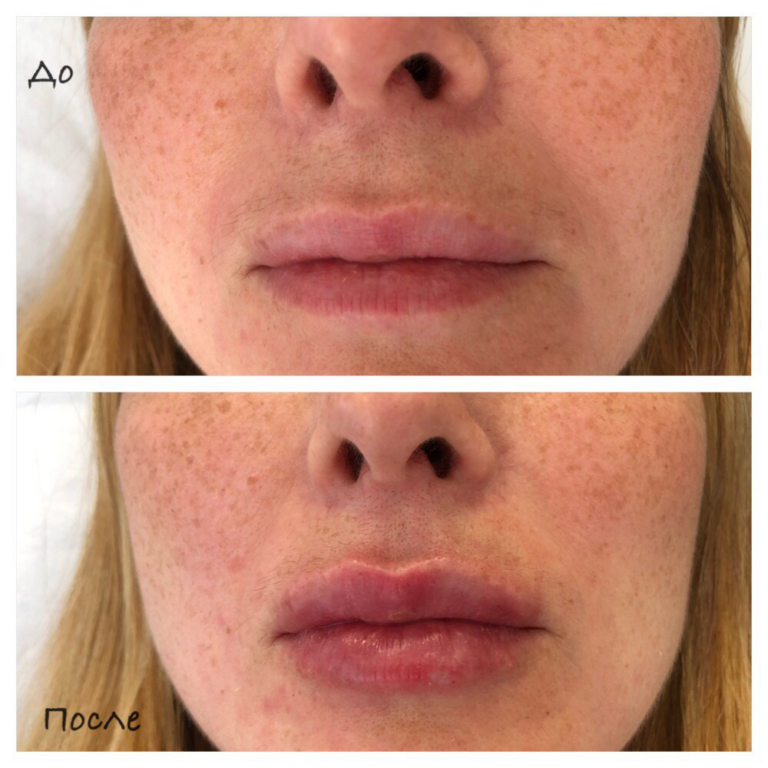 chto-stoit-uznat-pered-uvelicheniem-gub-gialuronovoj-kislotoj